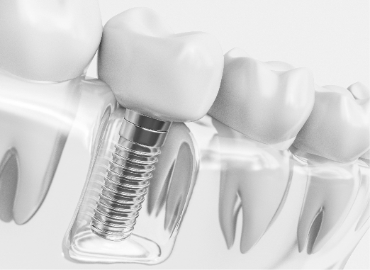 Dental Implants